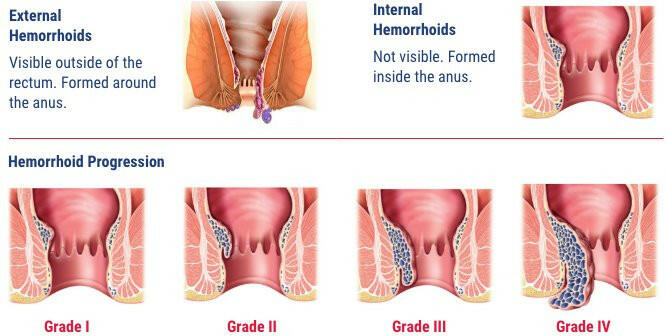 Hemorrhoids by Venixxa® – Diosmin-Based Relief for Hemorrhoid Symptoms | 36 Tablets - Image 3
